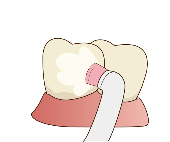 PMTCで虫歯、歯周病を予防