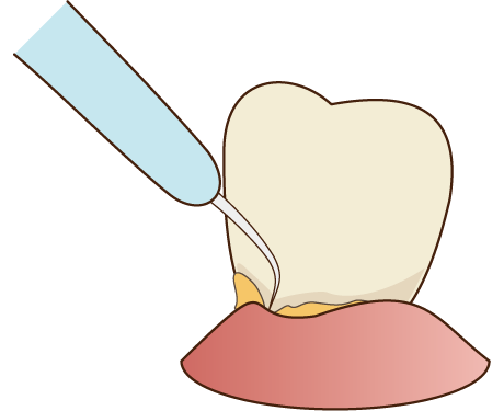 バイオフィルムを除去する