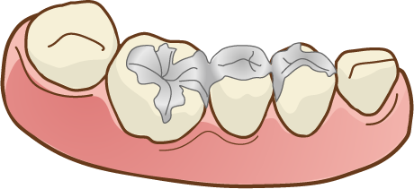 被せ物、ブリッジ、歯科矯正をしている方に効果的