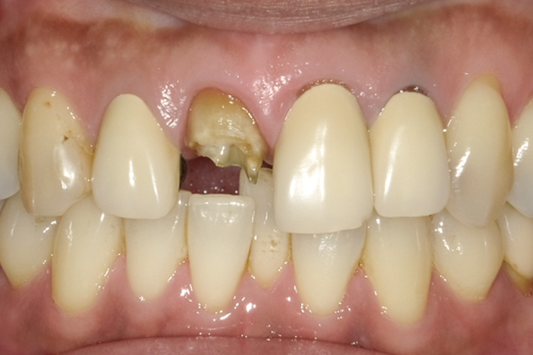 CADCAM冠 治療前
