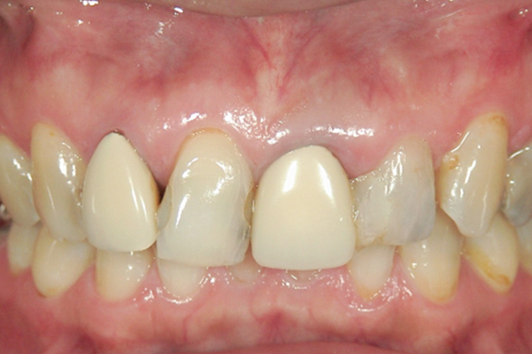 セレッククラウン 治療前