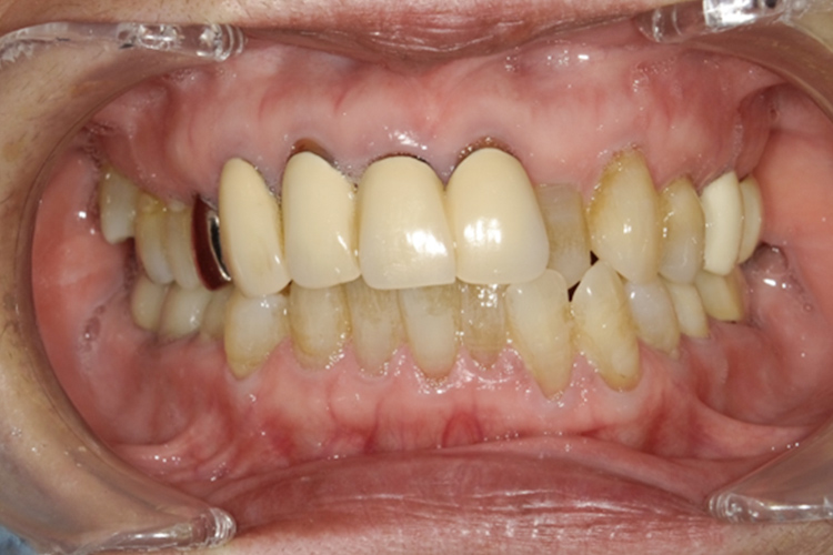 プレミアムジルコニアクラウン 治療前