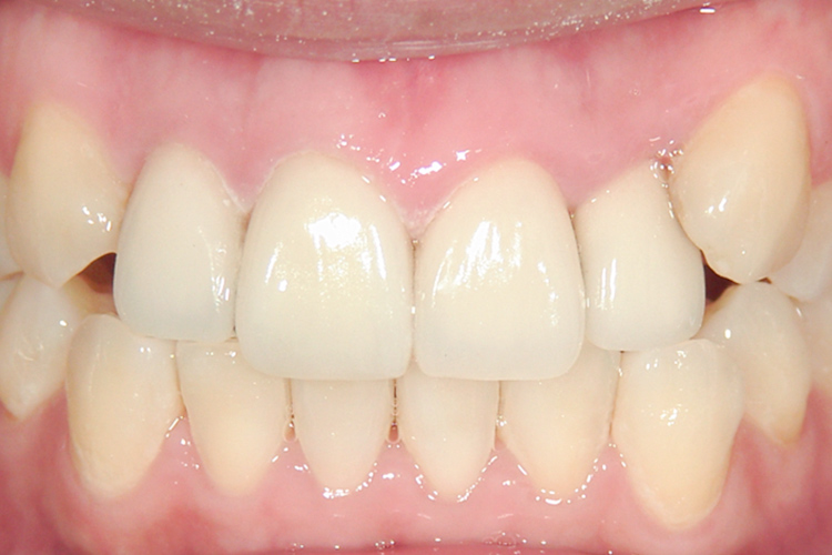 e-maxクラウン 治療後