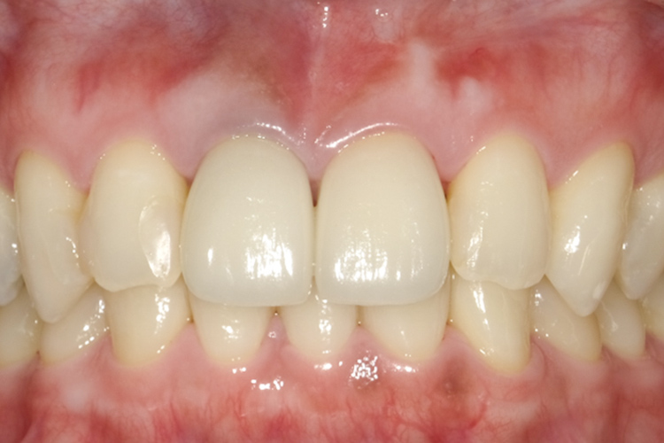 ポーセレンジルコニアクラウン 治療後
