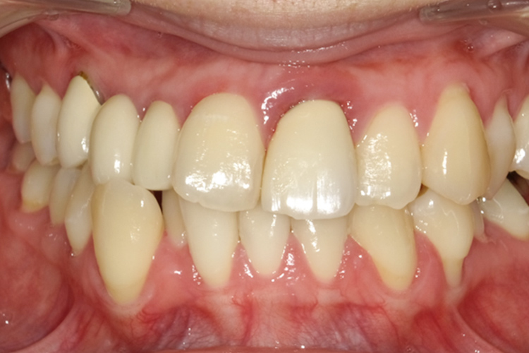 ストローマンインプラント 治療前