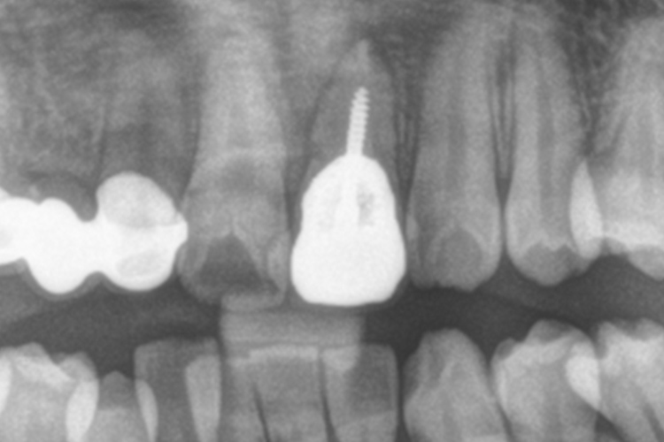 ストローマンインプラント 治療前