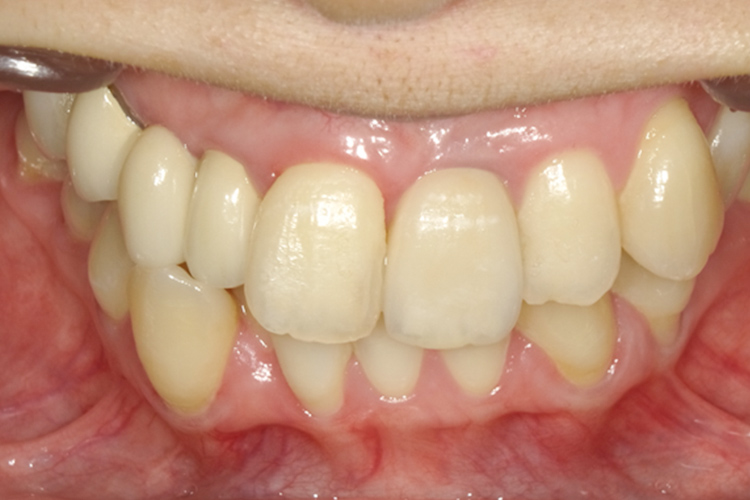 ストローマンインプラント 治療後