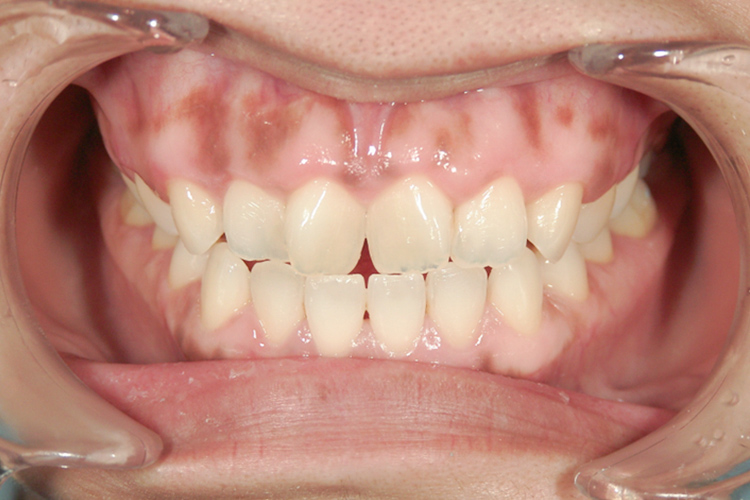 アソアライナー 治療前