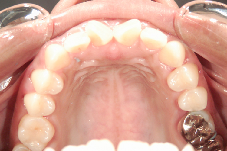 アソアライナー 治療前