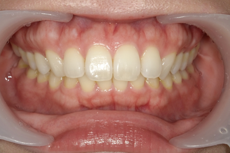 成人拡大装置 矯正前