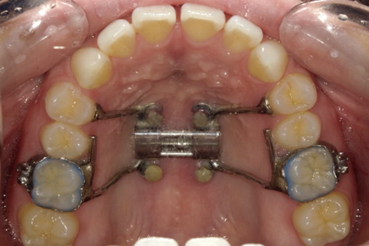 成人拡大装置 矯正前