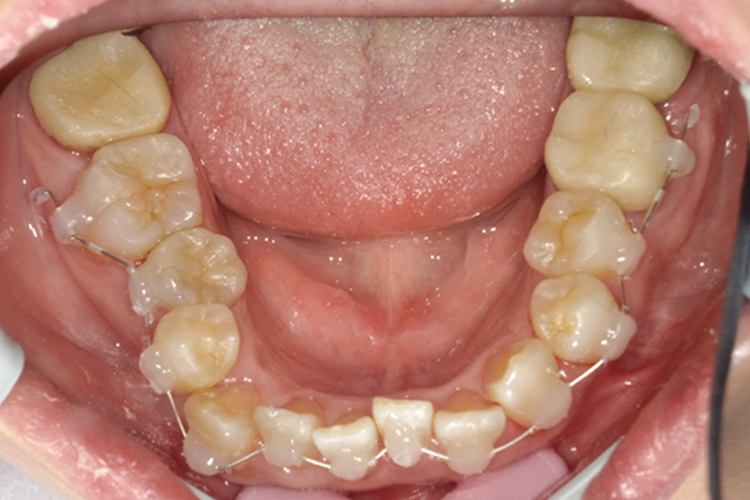 成人拡大装置 ブラケット
