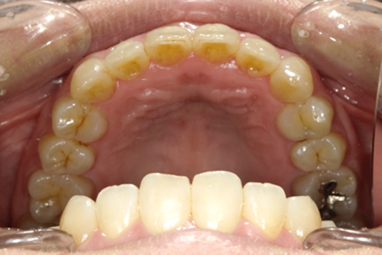 成人拡大装置 矯正後