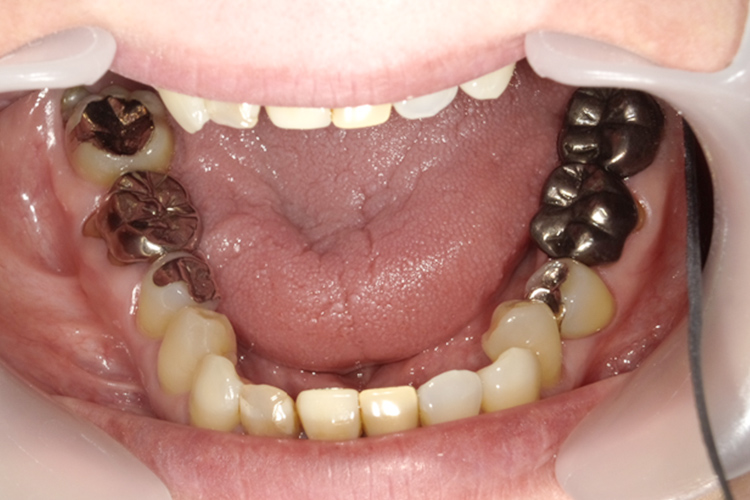 部分矯正 矯正前