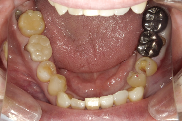 部分矯正 矯正後