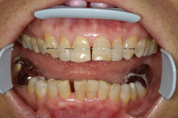 成人拡大装置 矯正前