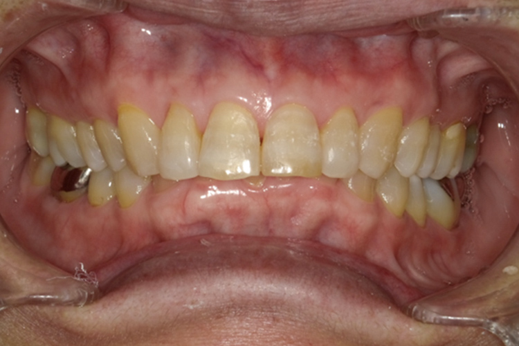 成人拡大装置 矯正前