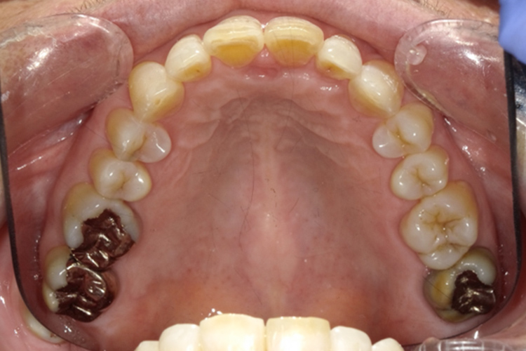 成人拡大装置 矯正前