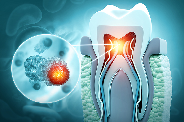 歯周病原菌、う蝕関連菌検査