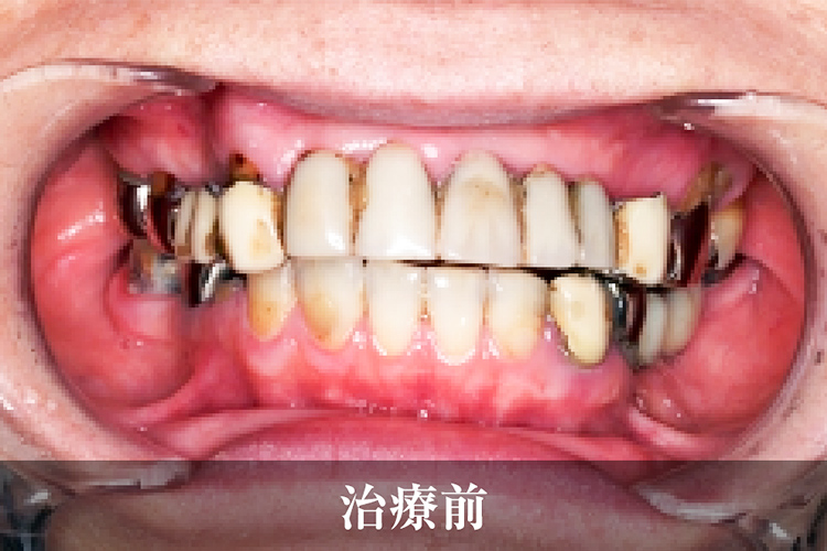 義歯 治療前
