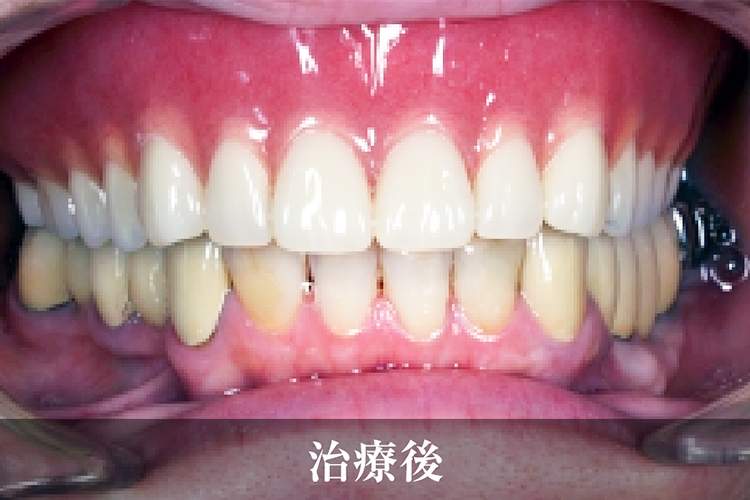 義歯 治療後