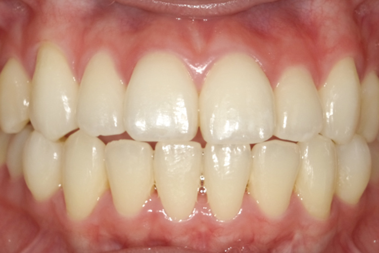 ホームホワイトニング　治療後