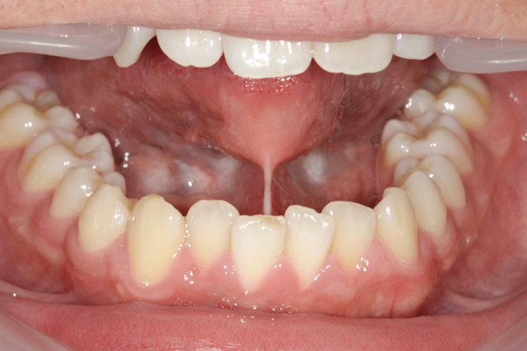 舌小帯手術 治療前